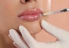 Lip Filler: Všetko, čo potrebujete vedieť o zväčšení pier kyselinou hyalurónovou